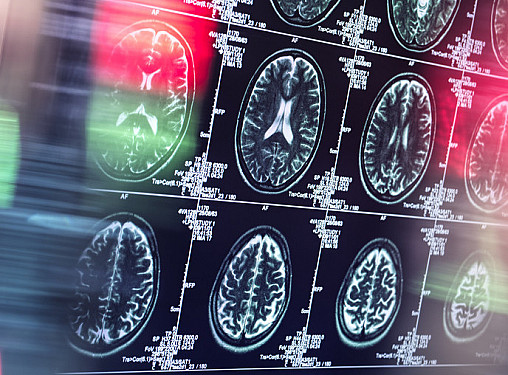 Dementia and frailty increase odds of dying after major surgery featured image