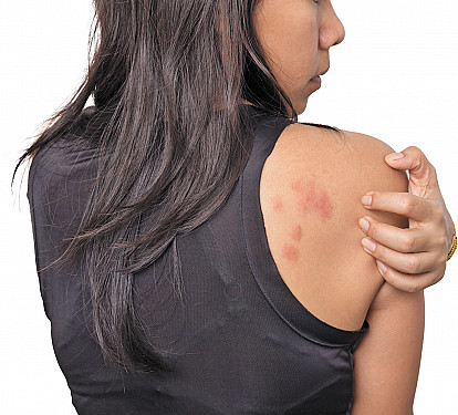 Why won't my hives go away? featured image