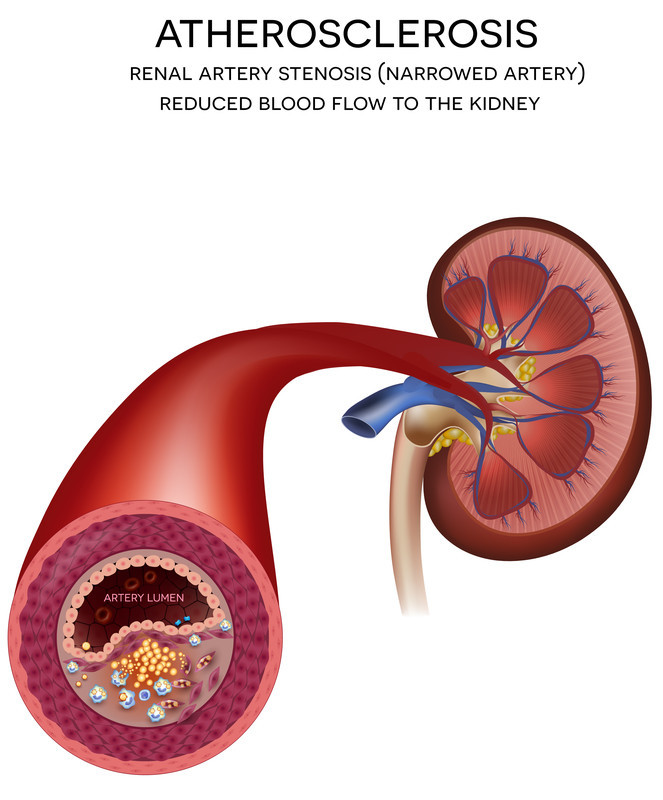 An illustration of renal artery stenosis.