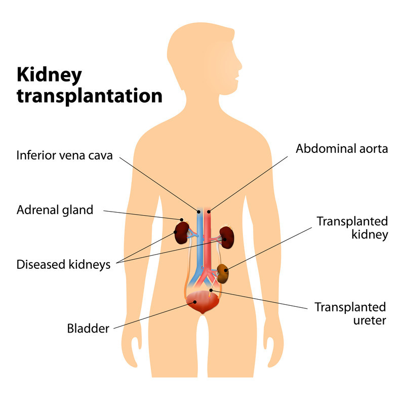 A medical illustration of a kidney transplantation. 