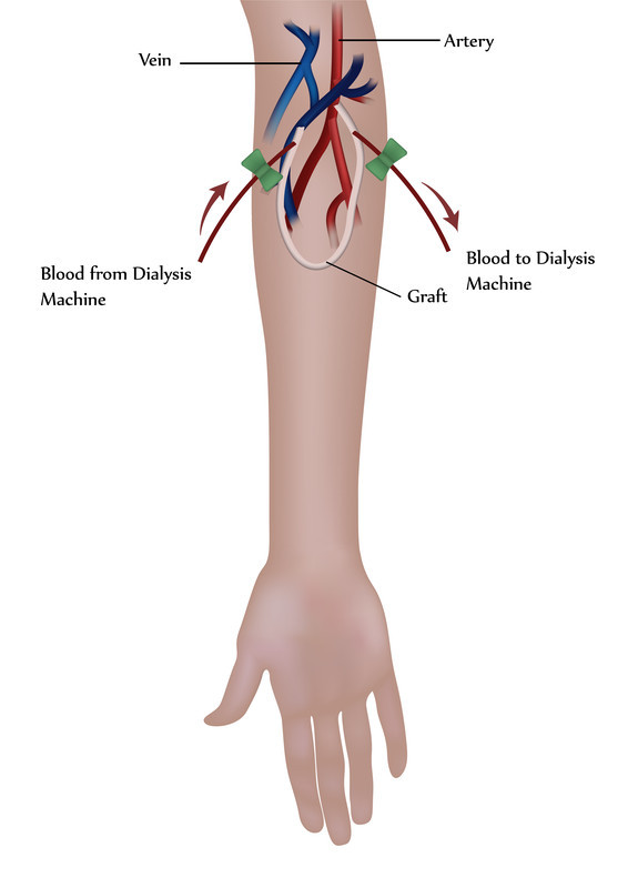 A medical illustration of hemodialysis.