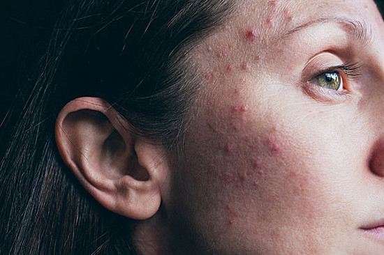 Adult female acne: Why it happens and the emotional toll featured image