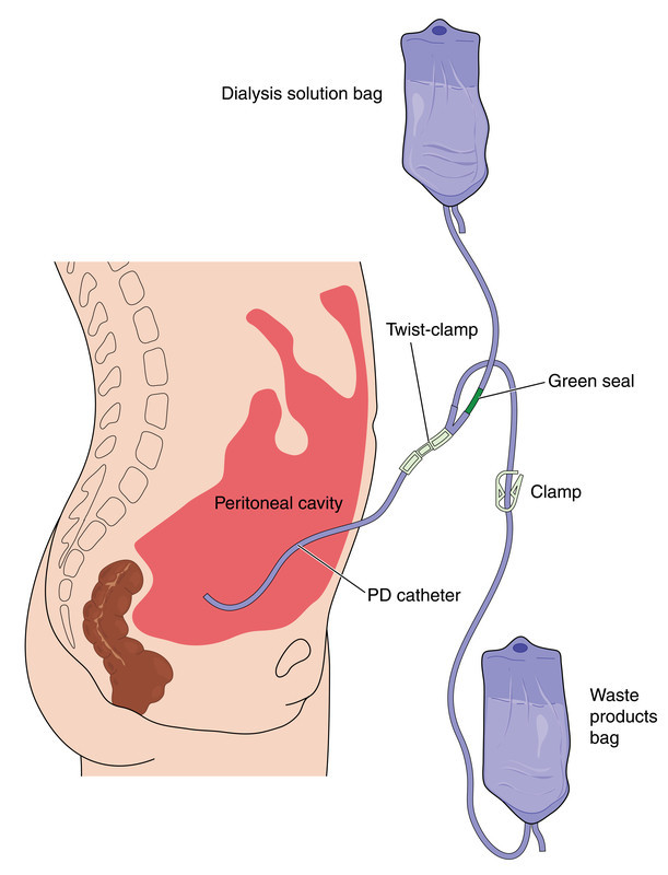 A medical illustration of peritoneal dialysis.
